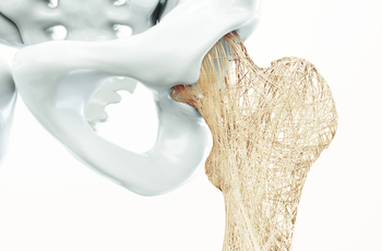 Остеопорозом называется патология костной ткани, которая сопровождается «вымыванием» из нее кальция и фосфора. Из-за этого кости становятся пористыми и непрочными. При данном заболевании значительно повышается риск переломов.