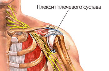 Плексит – это воспаление нервов в той или иной части человеческого тела. Чаще всего болезнь развивается в шее, плечах и пояснично-крестцовом отделе позвоночника. Более подробно остановимся на плечевом плексите и способах его лечения дома.