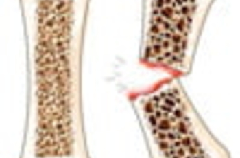 Особенностью остеопороза является значительная затрудненность выявления этого заболевания на ранней стадии. При остеопорозе нарушается обмен кальция в организме, в результате чего происходит истончение костных структур.