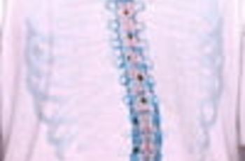Сколиоз – это стойкое боковое искривление позвоночника. Характеризуется сильным отклонением положения позвоночного столба от нормального выпрямленного состояния.