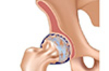 Артроз тазобедренного сустава — весьма грозное заболевание, проявляющееся болью и потерей функциональной подвижности, которая возникает за счёт разрушения хряща, расположенного на суставных поверхностях.