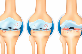 При гонартрозе коленного сустава 2 степени формируется деформация хрящевой ткани, что приводит к образованию разрастаний кости. Несмотря на выраженность симптомов на этой стадии, при своевременном обращении болезнь поддаётся лечению.