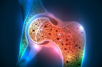 Выявление остеопороза (заболевания, при котором снижается минеральная плотность костной ткани, отчего кости становятся ломкими) крайне затруднено из-за того, что на ранней стадии болезнь себя практически никак не проявляет.