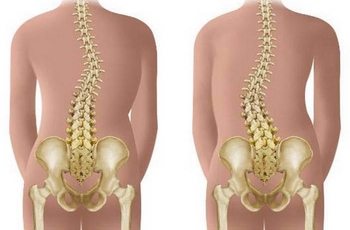 Заболевание спины, включающее в себя искривление шейно-грудного отдела позвоночника сразу в двух плоскостях, называется – кифосколиозом. Это название состоит из двух терминов: сколиоз и кифоз. Сколиоз – отклонение позвоночника в боковую сторону от нормаль