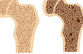 Остеопороз - это прогрессирующее системное заболевание скелета, которое характеризуется нарушением структуры костной ткани и снижением ее плотности. При возникновении этого заболевания даже небольшие нагрузки на кости могут привести к перелому, так как он