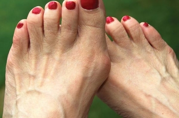 На сегодняшний день ортопеды используют различные методы для борьбы с деформациями косточек на ноге. Таким заболеванием страдают только женщины. Все это связано с тесной обувью и накопленными солями. Как же бороться с такой неприятностью как косточки на пальцах ног?