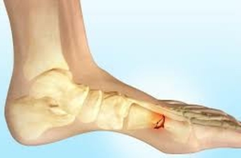 Рассматривается возможность восстановления ног в области стопы и голени при помощи комплекса упражнений. Приводятся заболевания, при которых рекомендуется их выполнять. Также рассматриваются упражнения для разных этапов выздоровления. 