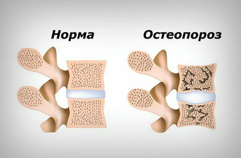 Самый простой и доступный метод первичной диагностики остеопороза - специальные тесты на риск его развития. Всемирная организация здравоохранения разработала методику FRAX, которая оценивает риск возникновения у человека переломов.