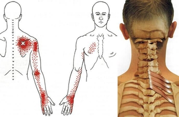 Довольно часто при высоких нагрузках на спину или при остеохондрозе возникает мышечно-тонический синдром. К этому состоянию приводит дегенеративное повреждение позвоночника. Одна из разновидностей заболевания – лопаточно-реберный синдром. 