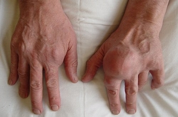 Образование гранулем или подагрических шишек на кистях рук говорит о том, что такое заболевание как подагра активно прогрессирует и требует незамедлительного лечения, так как оказывает негативное влияние и на внутренние органы.