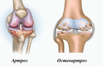Как распознать остеоартроз, какая симптоматика у данного заболевания и есть лечение? Как правило, данная патология встречается у представительниц женского пола старше 45 лет из-за профессиональной нагрузки на суставы верхних конечностей.