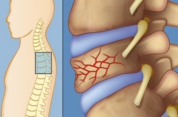 Одной из причин возникновения болей в спине, и, в частности, в грудном отделе, может быть компрессионный перелом. Компрессионный перелом – нарушение анатомической целостности костной ткани позвоночника.