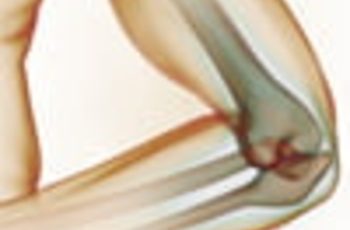 Воспаление суставной головки локтя, спровоцированное артритом, как правило, сопровождается поражением близлежащих суставов (например, плечевого).