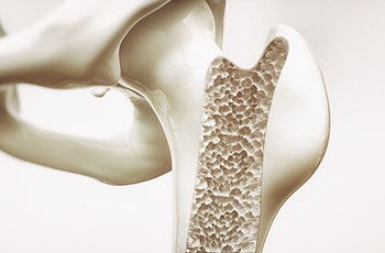 Остеопороз – это заболевание, при котором происходит истончение костной ткани в результате снижение способности организма восстанавливать костную структуру. При этом кальций из костей вымывается быстрее, чем организм способен его восстанавливать.