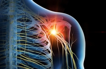 Боль в плече мешает руке двигаться. Из-за патологии поражаются волокна плечевого сплетения. Лечение начинают при появлении первых симптомов, его дополняют разными процедурами для восстановления поврежденных нервных окончаний.